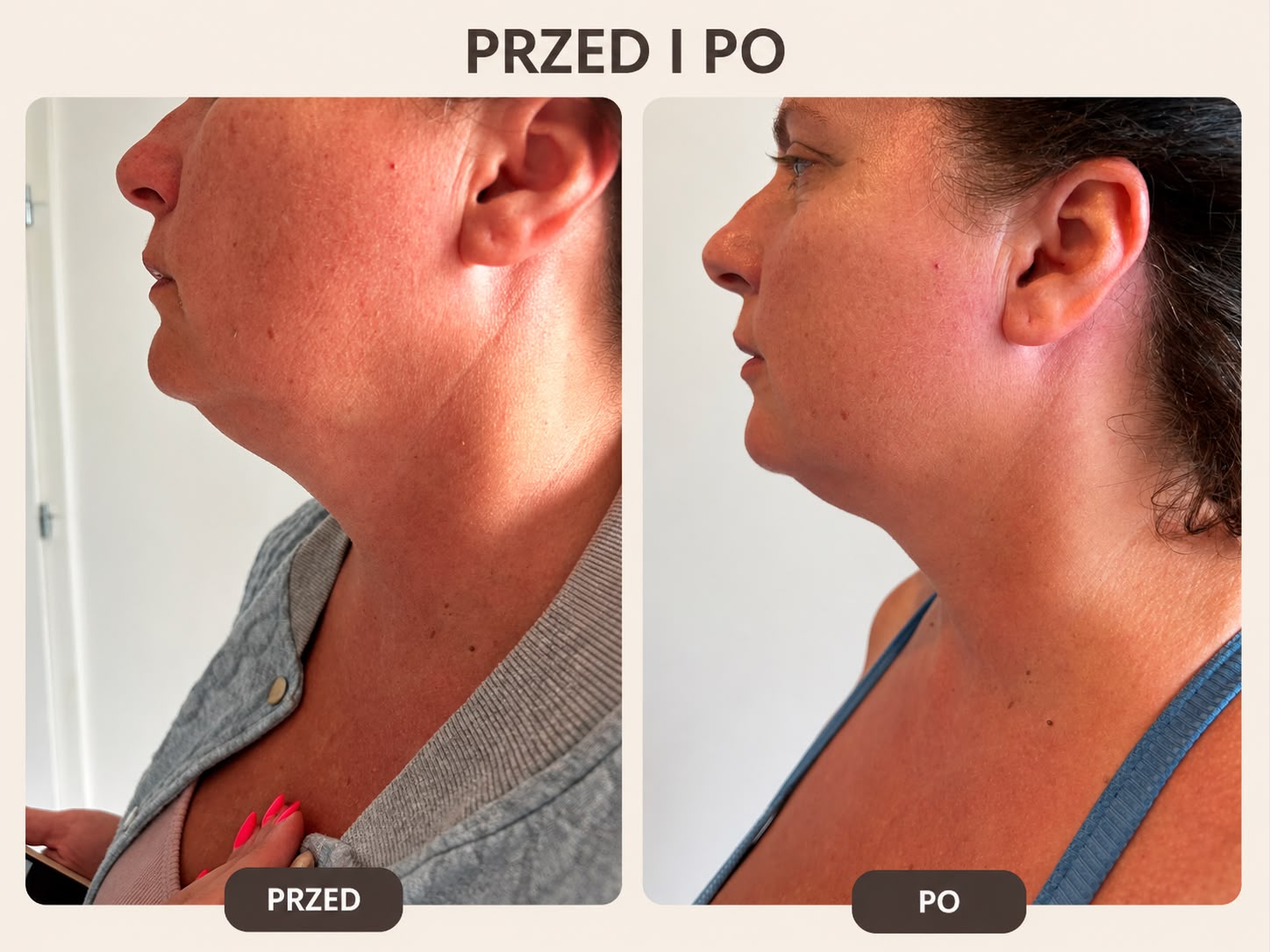 Porównanie podbródka przed i po