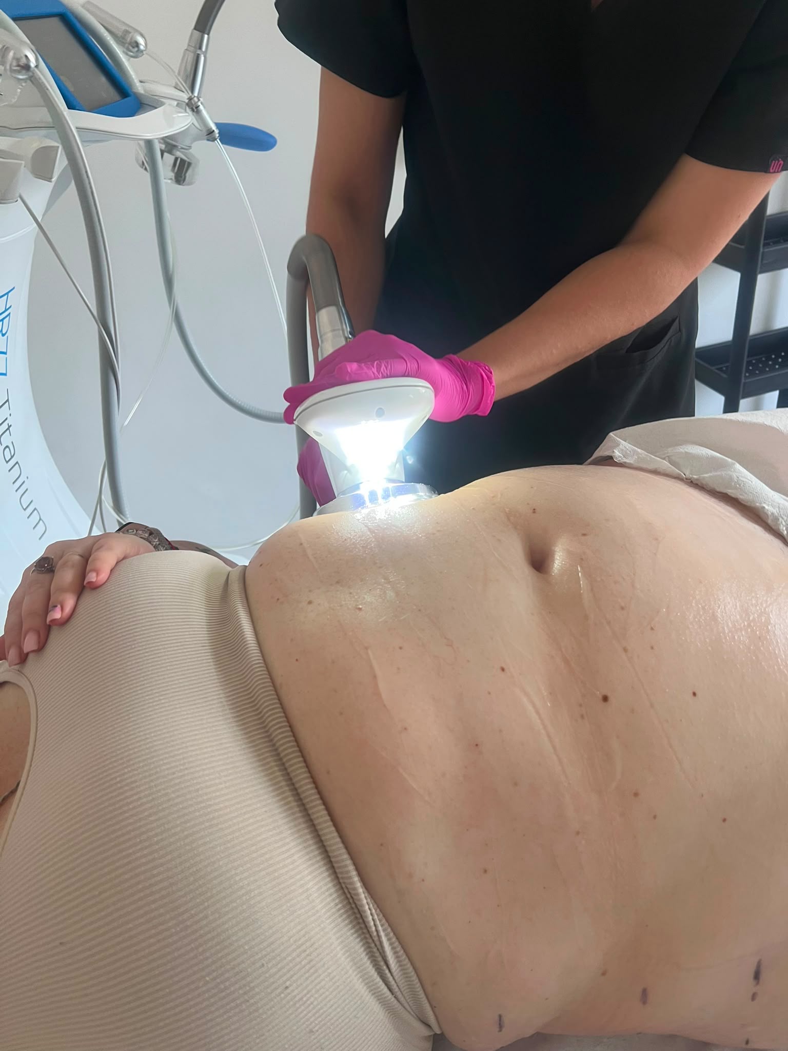 Praca głowicą EXIMIA podczas zabiegu na brzuch